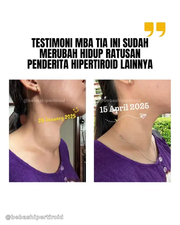 Perbandingan kondisi leher Tia sebelum dan sesudah menjalani proses pemulihan