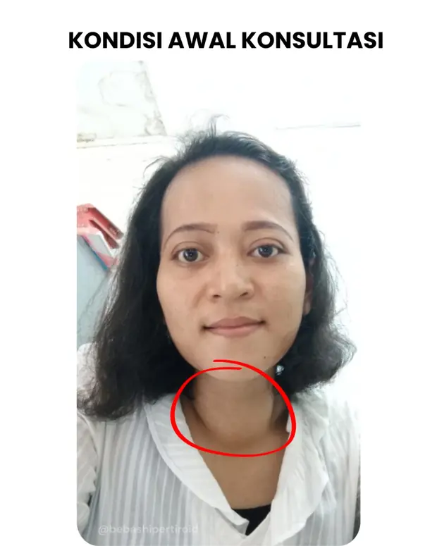 Kondisi awal Desi saat konsultasi setelah 15 tahun mengalami hipertiroid Graves