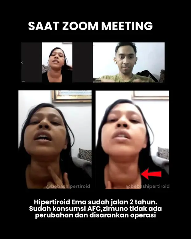 Kondisi Ema saat Zoom sebelum menjalani proses pemulihan