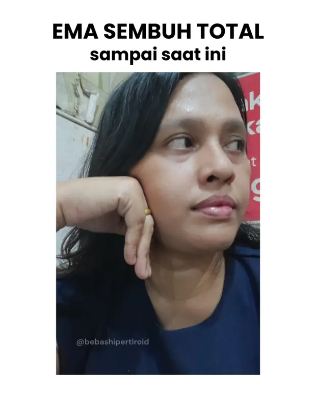 Kondisi Ema setelah sembuh dari hipertiroid