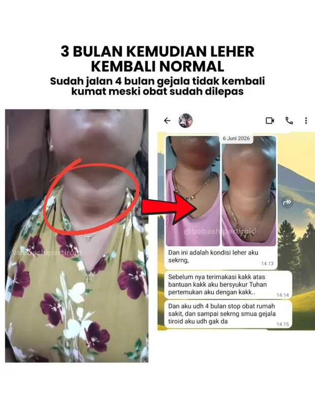 Perubahan kondisi leher Priska yang kembali normal tiga bulan kemudian
