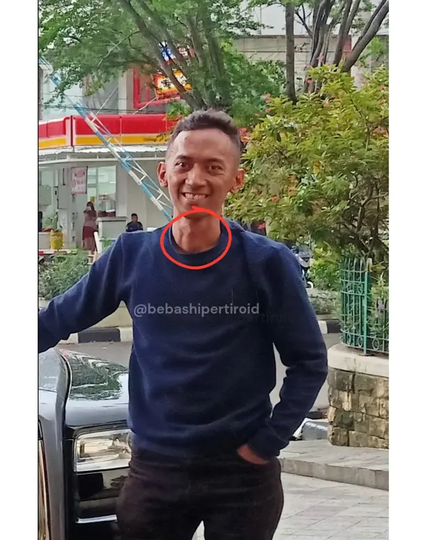 Kondisi Cliff sebelum pulih dari hipertiroid, foto 5