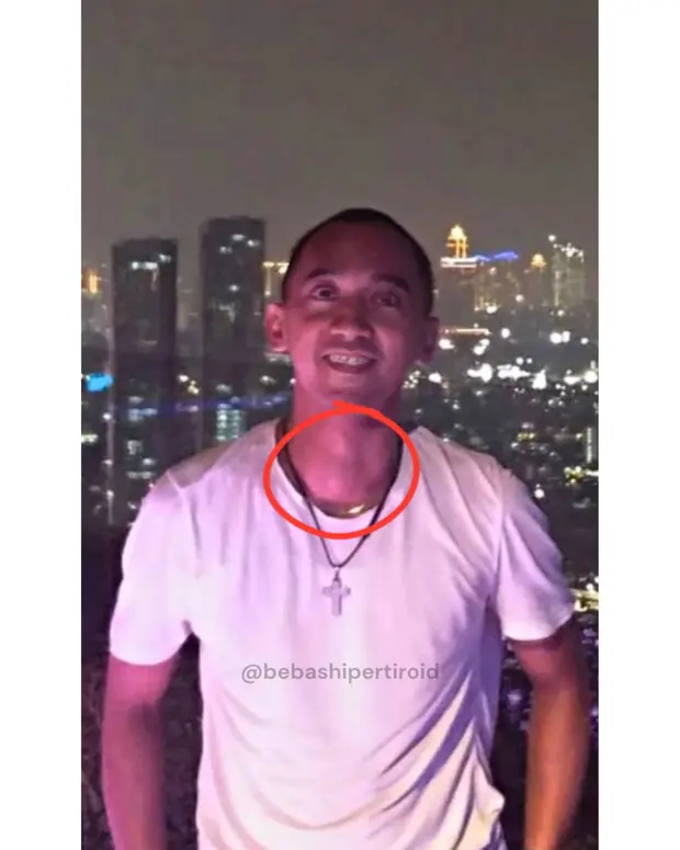 Kondisi Cliff sebelum pulih dari hipertiroid, foto 6