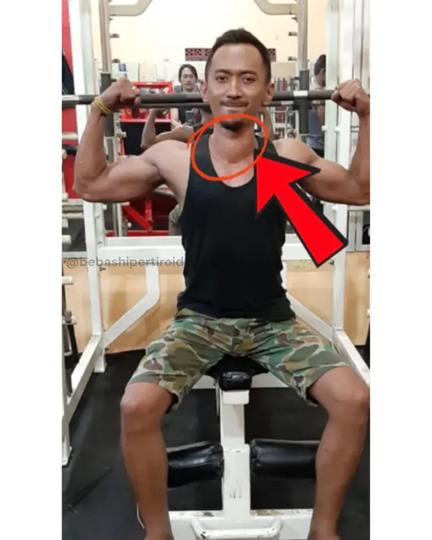 Kondisi Cliff sebelum pulih dari hipertiroid, foto 7