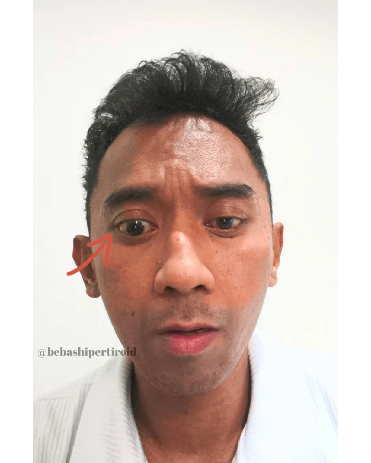 Kondisi Cliff sebelum pulih dari hipertiroid, foto 9