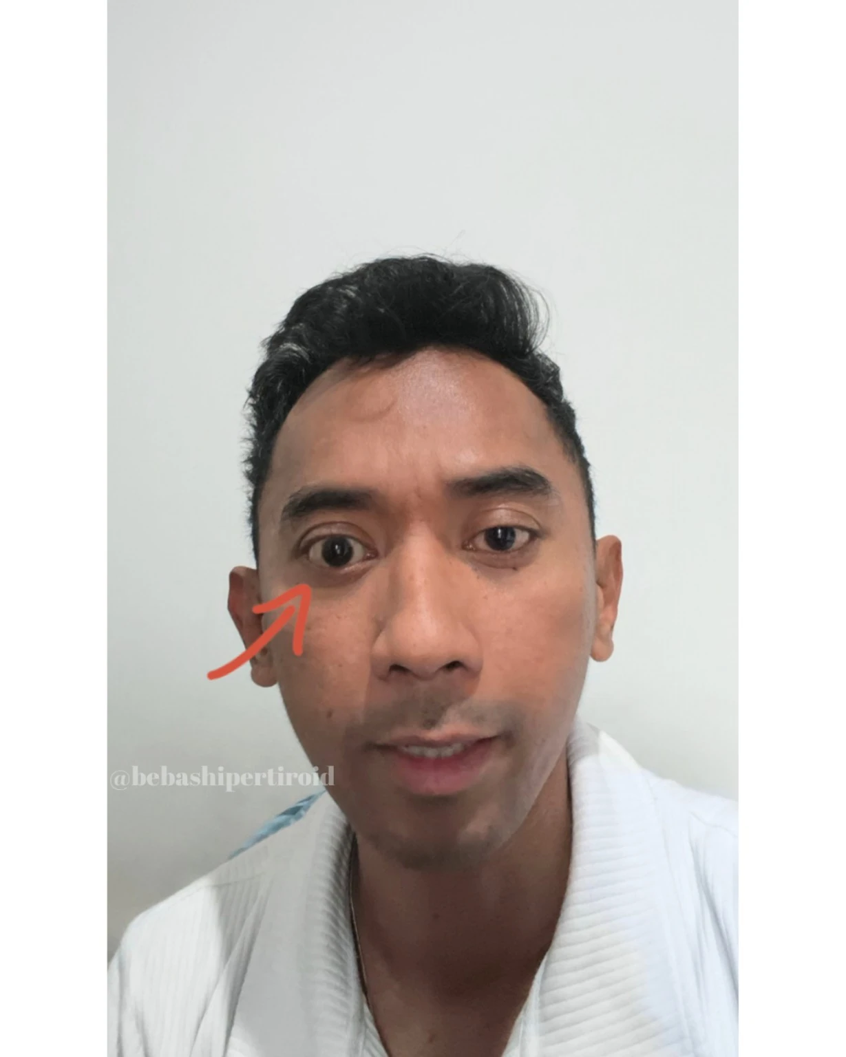 Kondisi Cliff sebelum pulih dari hipertiroid, foto 10